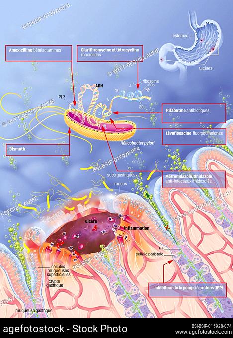 Ulceration of the gastric mucosa with Helicobacter pylori, and treatments. Zoom on the gastric mucosa seen in section. On the left