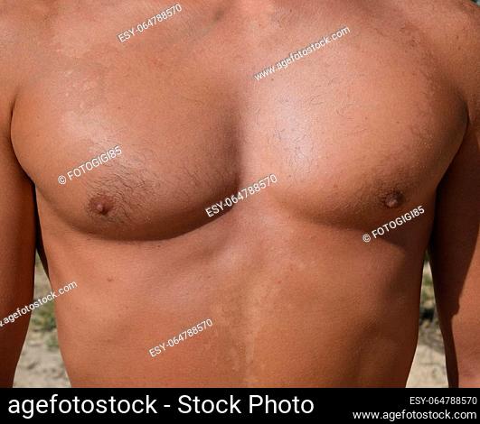 Sunburn on the skin of the chest and abdomen of a man. Exfoliation, skin peels off. Dangerous sun tan