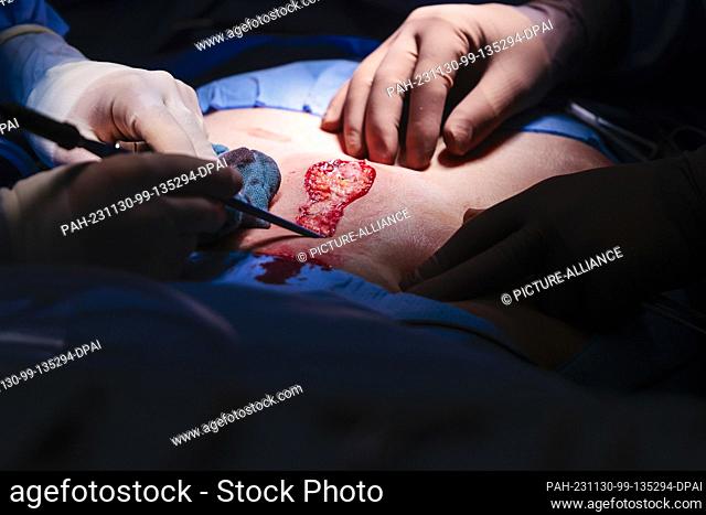 PRODUCTION - 29 November 2023, Schleswig-Holstein, Rendsburg: Two doctors perform an abdominal operation in the Schön Klinik's surgery center
