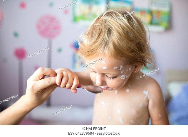 Little two year old girl at home sick with chickenpox, white antiseptic cream applied. Unrecognizable mother giving her medicine on spoon, eating it