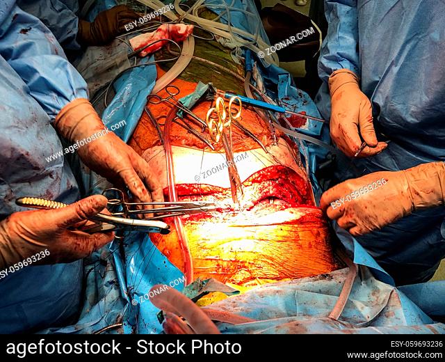 Close up of surgeon team performing real medical sternotomy, open chest, organ transplantation surgery on patient. Healthcare and medicine
