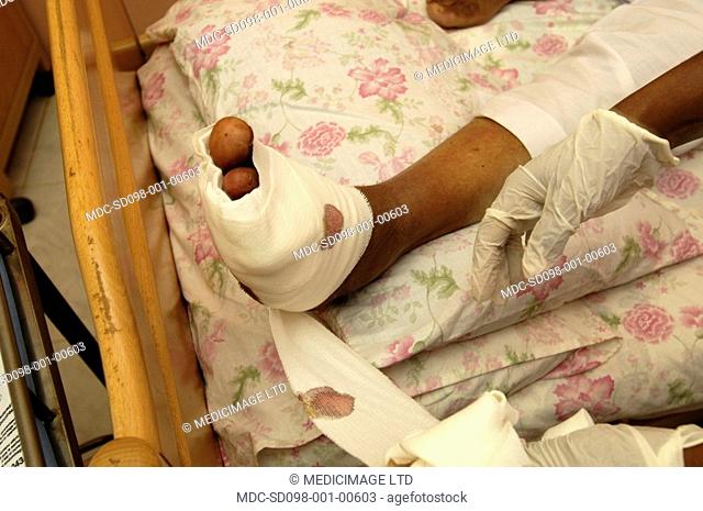 A patient is having their foot bandaged as suffering with diabetic septic foot. /nUnregulated hyperglycaemia high blood glucose levels leads to non-enzymic...