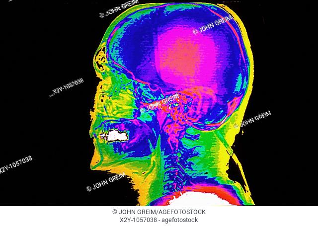 Color CAT scan of the lateral skull