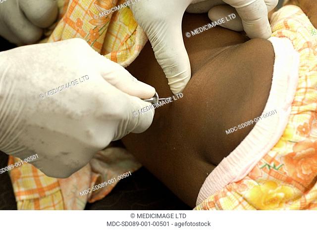 A patient undergoing a lumbar puncture spinal tap. This is a procedure where a sample of cerebrospinal fluid is obtain from the lumbar spine via the space...