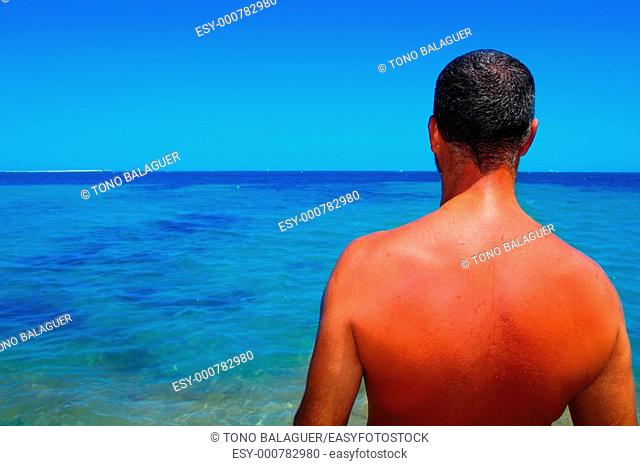 tanned sunburned red skin man back summer vacation sea ocean