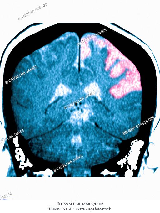 Cerebral atrophy. Parietal cortico-sub-cortical atrophies (aftereffects of left, frontoparietal parenchymal ischemia), seen on a frontal cross-section brain CT...