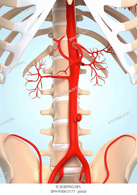 Aortic aneurysm. Computer artwork of a saccular aortic aneurysm