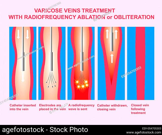 Varicose Veins. Treatment with radiofrequency ablation orobliteration of female legs