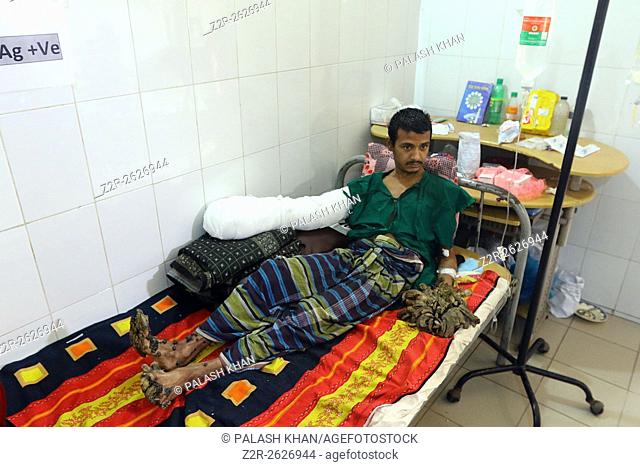 Bangladeshi man rests after a surgery at Dhaka Medical College Hospital in Dhaka on Feb. 23, 2016. A Bangladeshi man dubbed tree man due to large bark-like...