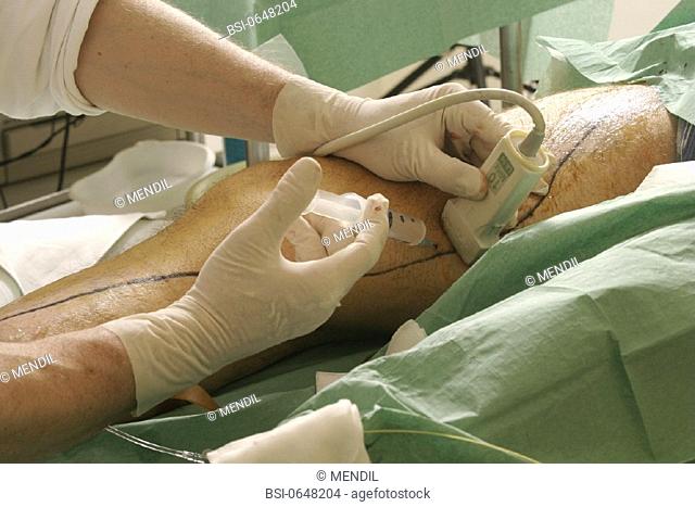 VARICOSE VEIN, SURGERY<BR>Photo essay from hospital.<BR>Perivenous anesthesia under guidance of ultrasound