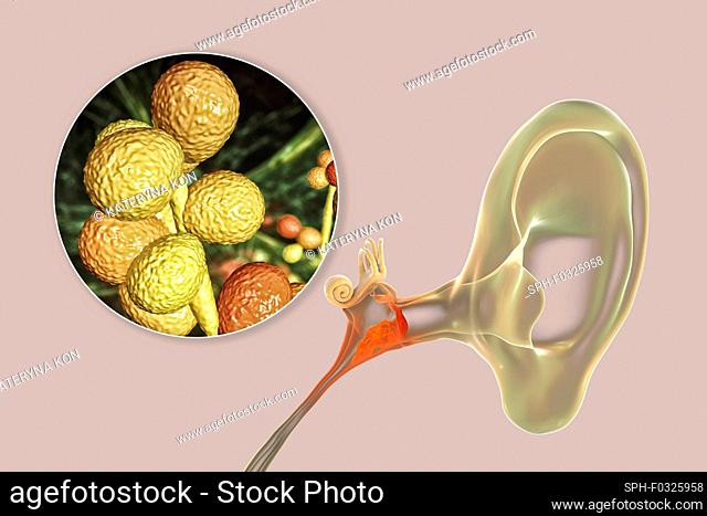 Chronic fungal otitis media ear infection, illustration
