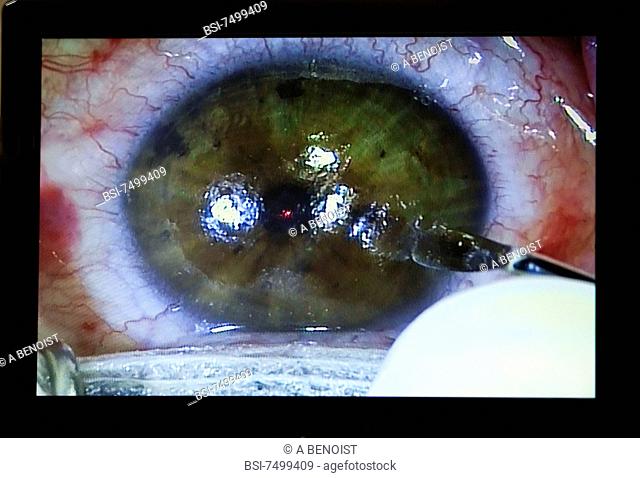 Photo essay on multifocal surfery of the eye with personalized laser LASIK. In a first time a corneal disk thin lamelle of cornea is cut up by femtoseconde...