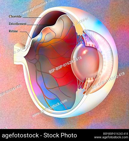 Eye: detachment of the retina, which detaches from the underlying choroid