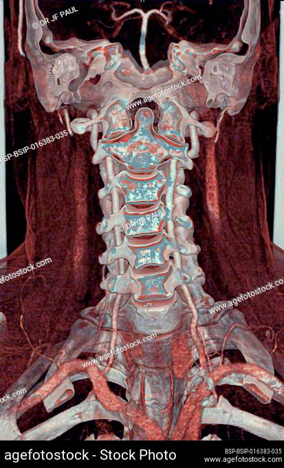 Cervical vertebrae, 3D CT scan