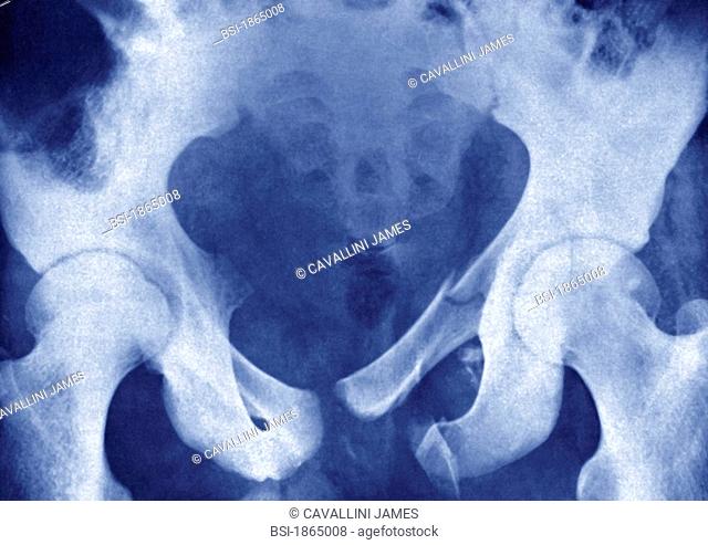 FRACTURED PELVIS, X-RAY Fractured pelvis  pubic symphysis, ischium, sacrum, coccyx. X-ray of the pelvis in front view