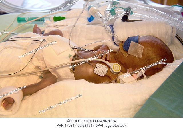 A 5-day-old boy who weighed 430 grams at birth, in an incubator at the children's clinic of Hannover Medical School (Medizinische Hochschule Hannover