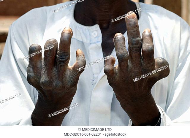 An elderly male leper with mutilated hands. Leprosy Hansen's disease is a chronic infectious disease caused by Mycobacterium leprae, an acid-fast
