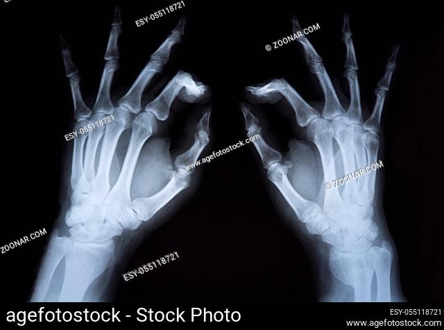Medical x ray hands image