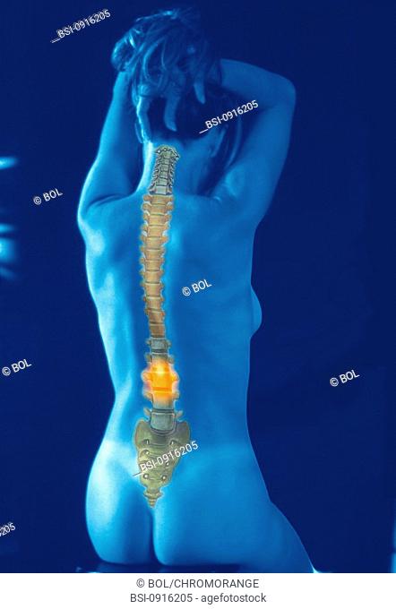 SPINAL COLUMN, DRAWING<BR>Worldwide distribution except for United Kingdom and Germany.<BR>Blue picture of the backside of a nude woman