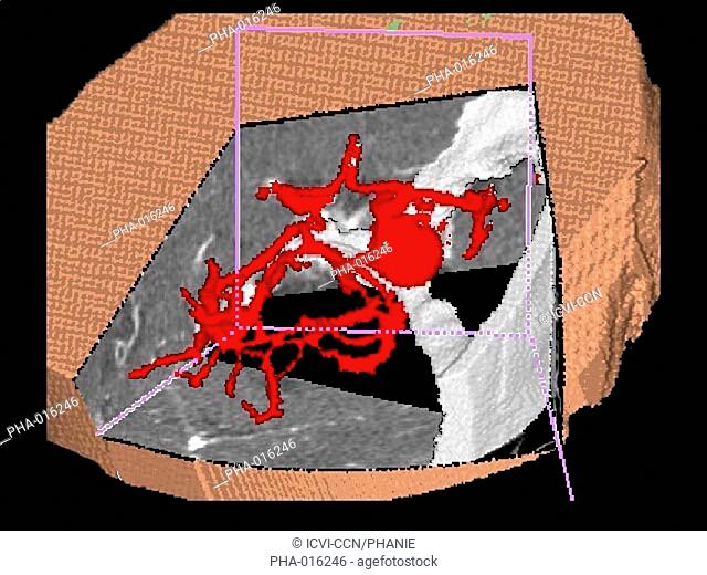 Three-dimensional computed tomographic view of the base of a skull showing a 9 mm diameter intracranial aneurysm red ballon shaped swelling located on the left...