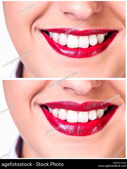 Lips before and after filler injections isolated on white. Lips augmentation concept