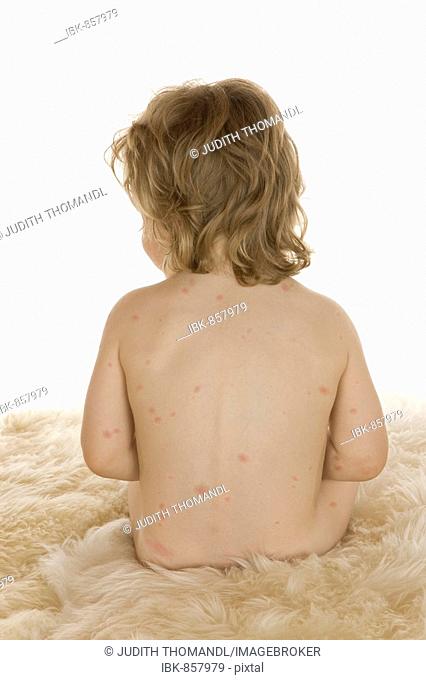 Toddler, 2 years old, with chickenpox