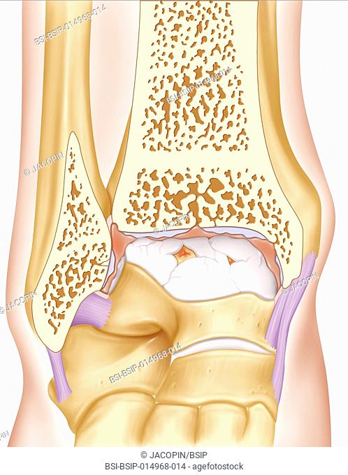 Illustration of osteoarthritis in the ankle. Bone and cartilage damage most often due to age, which deforms the joint and inflames the synovial membrane
