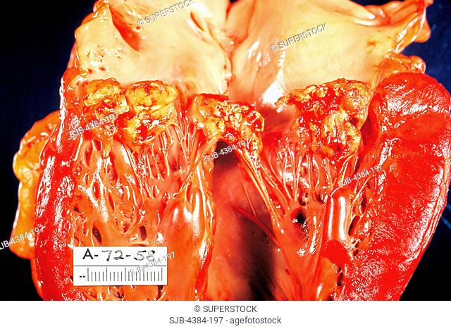 The left ventricle of heart has been opened to show mitral valve fibrin vegetations due to infection with Haemophilus parainfluenzae