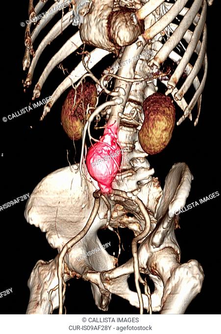 CT scan image showing an abdominal aortic aneurysm