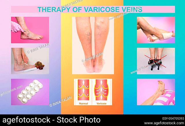 Collage about therapy or treatment of varicose veins