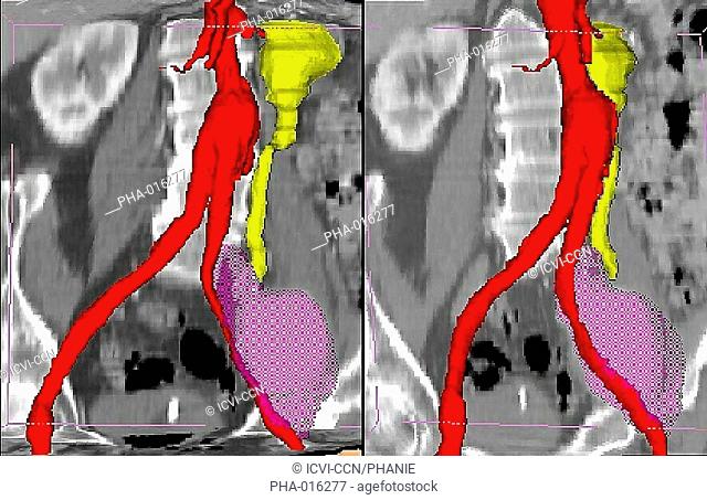 3D computed tomography CT scan showing the rupture of a prosthesis on the left external iliac artery at right, due to the rupture of the threads maintaining the...