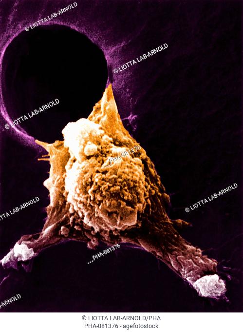 Scanning electron micrograph SEM of a cancerous cell showing pseudopodia  pseudopod . This arms are generated by a protein named autocrine motility factor AMF...