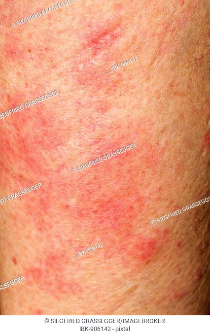 Skin rash, Urticaria