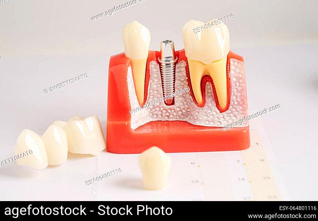 Dental implant, artificial tooth roots into jaw, root canal of dental treatment, gum disease, teeth model for dentist studying about dentistry