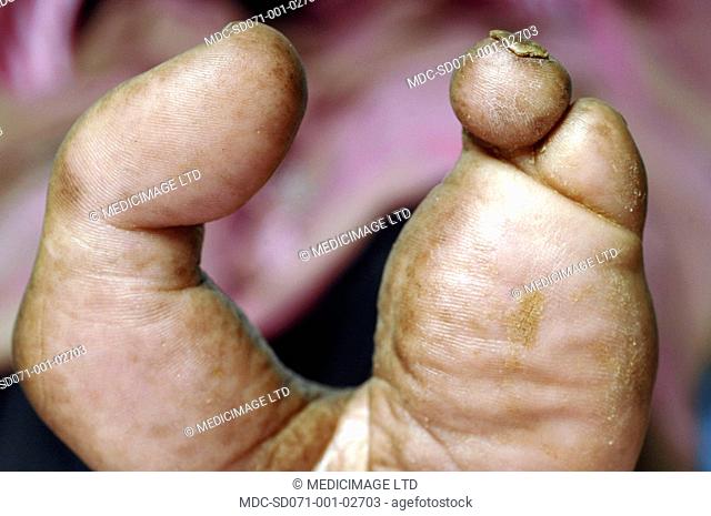 Close up of a left foot with second, third and fourth toes amputated