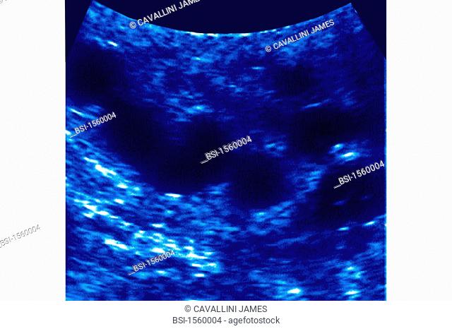 VARICOCELE<BR>Dilation of pampiniform plexus in testicle, possibly the cause of infertilty. Ultrasound of testicle. Varicocele