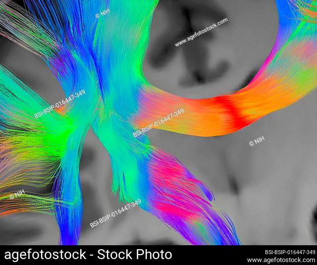 This spread spectrum imaging scan, which samples 257 directions over a range of different gradient strengths, shows tractography at a triple crossover in the...