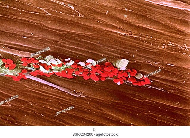 Cluster of platelets on capillary's injured endothelium. SEM 1000x
