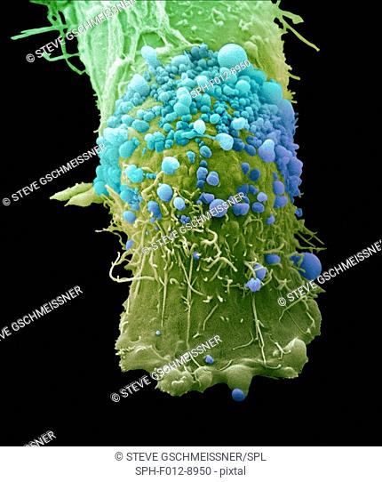 Skin cancer cell, coloured scanning electron micrograph (SEM). Cultured melanoma cell showing the numerous blebs and microvilli characteristic of cancer cells