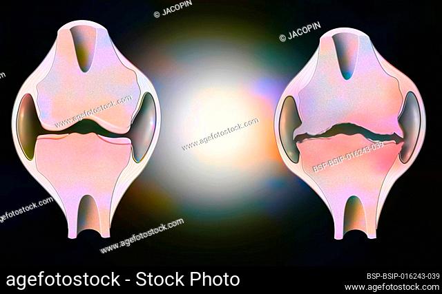 Anatomy of the joint of a healthy knee on the left, and one deformed by osteoarthritis on the right