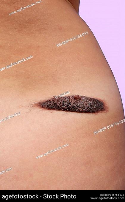 Congenital nevus of the back in a 28-year-old woman