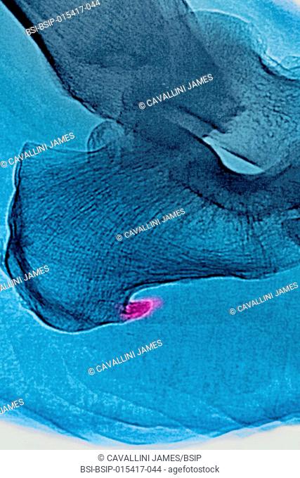 Enthesopathy: calcifications of the plantar fascia. Visualisation on saggital plane x-ray