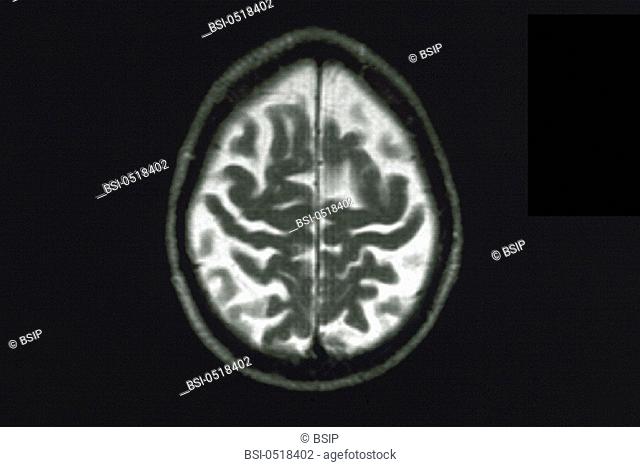 ALZHEIMER DISEASE, MRI<BR>Department of morphological and functional imaging, led by Professor Fredy, at the Pitié Salpêtrière Hospital in Paris, France