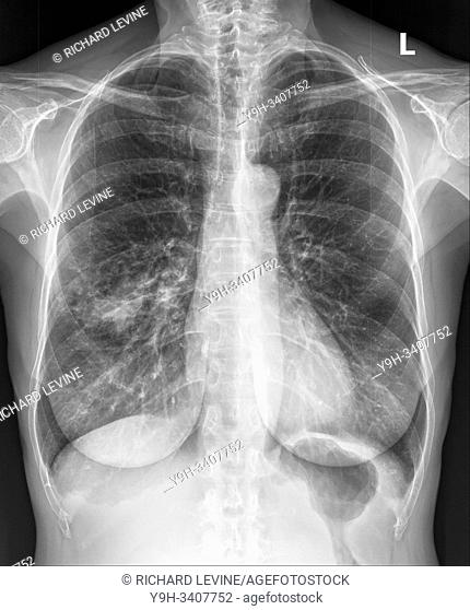 X-ray of woman' s chest on Friday, July 26, 2019. (© Frances M. Roberts)