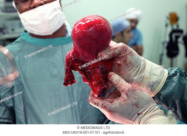 The bulbous, distended uterus is completely removed./n/n /n/nThe corpus and cervix uteri can both be seen in this shot, along with one of the Fallopian tubes on...