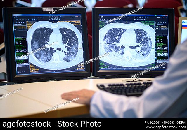 09 April 2020, Baden-Wuerttemberg, Stuttgart: Computed tomography images of the lungs of a Covid19 patient can be seen on two monitors at the Klinikum Stuttgart