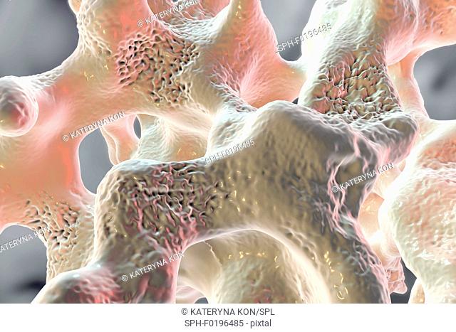 Osteoporosis, illustration