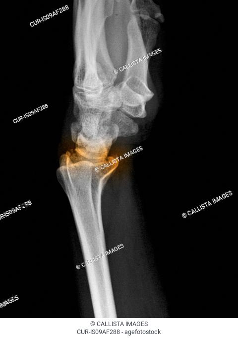 x-ray of a distal radius fracture