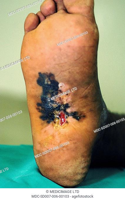 Close-up of a malignant melanoma on the heel of an elderly woman. Melanoma is a malignant tumour of melanocytes pigment producing cells found in the skin