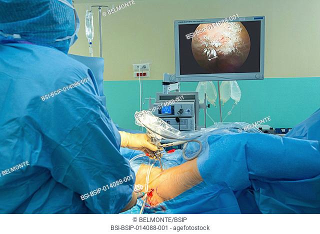 An arthroscopy of the hip. Femoroplasty on a sportsperson’s hip. The drill that will plane the bone excrescence responsible for the crushing of the cartilage...